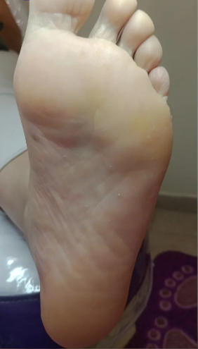 Después del tratamiento de Hiperqueratosis